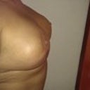 Day 13 Post Op