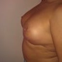 Day 13 Post Op