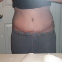 2 weeks post op in the evening after a day of shopping. Not looking bad :-)