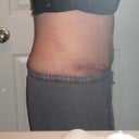 2 weeks post op