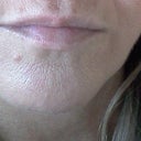 Another view before jaw line