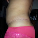 6 weeks P/O side