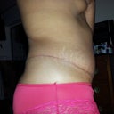 6 weeks P/O side