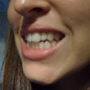 I guess the main thing that needs to be corrected is an overbite..