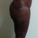 This side view doesn't look like I have a butt at all. I see the difference in volume compared to the before, but you can see the indentation at the top of my butt on the side below my waist.