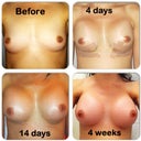 My right breast has the 2 freckles on it close to the armpit.  This is the smaller breast & my dominant side.  The teardrop shape implant is now visible at 4weeks.