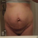 Before surgery with my twin skin, yuck!