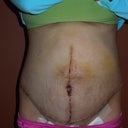 1 week post op, front view