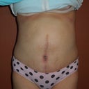 4 weeks post op, front view at night.  Still have bruising. My scar is a little crooked but considering how much he had to do, I don't mind.