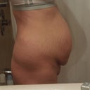 Before surgery side view, need extensive muscle repair