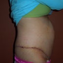 1 week post op side view, have a large hematoma over muscle repair above belly button (area that protrudes)