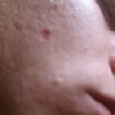 Noticeable red circle, scarring risk? Taken with cell phone camera, there is more redness in real life