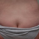 Seven weeks. See the tiny incision marks.