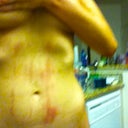 it's not right, and I don't understand how the ground pad not the heated ultrasound wand caused these burn marks?
