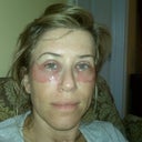 1 Day After Surgery
