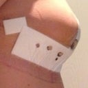 Day 4 post operation- right breast