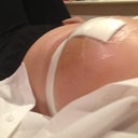 Day 5 post operation- close op of left breast, very swollen and bruised
