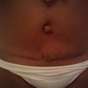 Close up of my incision week 5 it looks good but I have extra skin above my incision on my left below my navel. Dr might have to fix it.