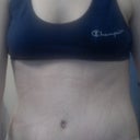 10DPO.  My belly button looks good to me, but about a half inch off center, i think.  Might be my scoliosis.  Drains are out.  HURRAY!!!
