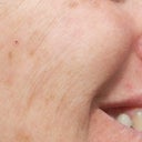 The damage continues four months later.The worst lines are when I smile.