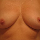 5 months post-op-I think they look pretty good!