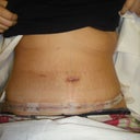 morning after surgery
