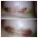 Top is (3/20/13) day of sutures removed. Bottom was yesterday (3/22/13)