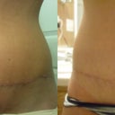 The scar