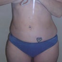 Day before beginning Smoothshapes - notice the uneven waistline and the dimpling along the scar from the Smartlipo port (not quite navel height on the left side of photo (which is my right side).