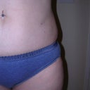 Day before beginning Smoothshapes - again, notice the indentation at the waist and around the Smartlipo scar.