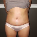 Day20 PO-super swollen after dinner