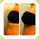 Left preop right today