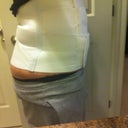 1 week post Op with compression garment on, it bunches in the back, I dislike this garment, and I hope it isn't going to ruin my results.