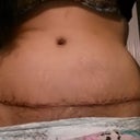 Scar after glue off and stitch removed no drain!!