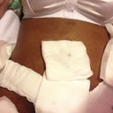 After surgery