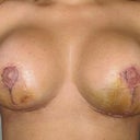 2 weeks post