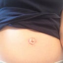Belly button hernia-need scar revision and hernia repair 