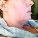 This was pre-surgery, side view