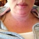 Pre surgery- front view