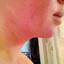 3 days post surgery, minimal swelling