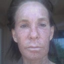 Day 4, still swollen, brown and slight peeling.