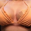 Day 10 tape to lt breast PS placed for better result after swelling