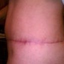 2 months scar