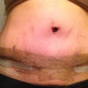 Taken on PO Day 12. Will get the tapes removed next week to have a look at the scar. Seems very low which is a great surprise! I still have a ton of stretch marks which are very visible but I'm okay with it. This tummy is far better than my old tummy!