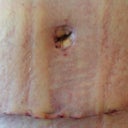 Scary close up of ZOMBIE belly button and incision Day 12 post op!  The crazy scary ridges are from the compression garment and swelling -- totally normal.  And both incision and button look BEAUTIFUL as far as I am concerned for Day 12 !