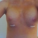 Day after. Took off the dressing and left the steri-strips on.