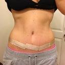 My BB might seem off center but that is due to the fact that I have more swelling on my left side, so it pulls my BB incision over.