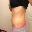 This is the side that is more swollen but is finally starting to go down.