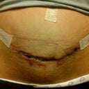 5 1/2 weeks post op boo boo