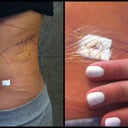 Day 3: Post-Op (Small yellow bruising/stitches very tiny)
